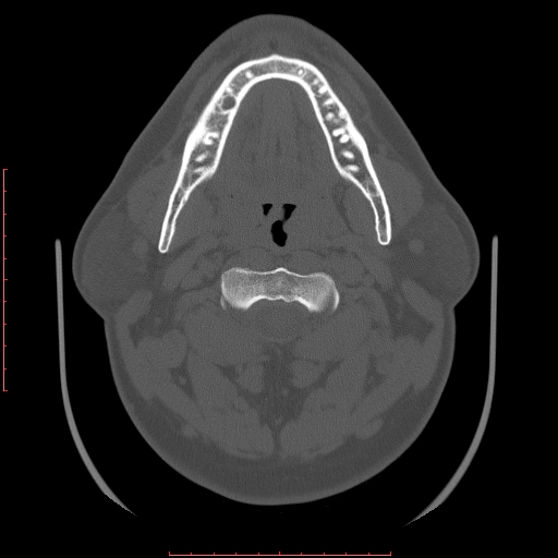 File:Chronic submandibular sialolithiasis (Radiopaedia 69817-79814 Axial bone window 51).jpg