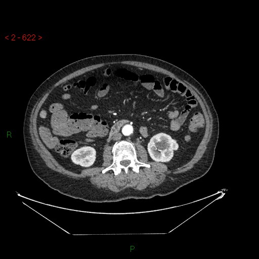 File:Circumaortic left renal vein and doubled left renal arteries (Radiopaedia 52268-58158 A 158).jpg
