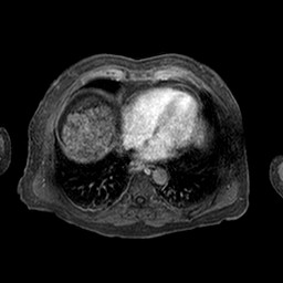 Cirrhosis and hepatocellular carcinoma in the setting of hemochromatosis (Radiopaedia 75394-86594 Axial T1 C+ fat sat 336).jpg