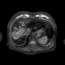 Cirrhosis and hepatocellular carcinoma in the setting of hemochromatosis (Radiopaedia 75394-86594 Axial T1 C+ fat sat 61).jpg