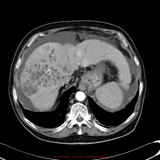 File:Cirrhosis and hepatocellular carcinoma in the setting of hemochromatosis (Radiopaedia 75394-86595 A 23).jpg