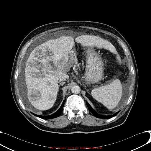 Cirrhosis and hepatocellular carcinoma in the setting of hemochromatosis (Radiopaedia 75394-86595 B 27).jpg