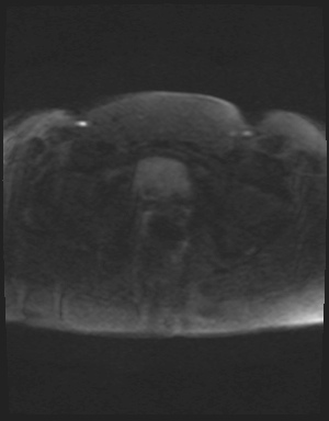 Class II Mullerian duct anomaly- unicornuate uterus with rudimentary horn and non-communicating cavity (Radiopaedia 39441-41755 Axial DWI 87).jpg