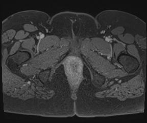 File:Class II Mullerian duct anomaly- unicornuate uterus with rudimentary horn and non-communicating cavity (Radiopaedia 39441-41755 Axial T1 fat sat 141).jpg