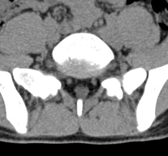 File:Clear cell meningoma - lumbar spine (Radiopaedia 60116-67691 Axial non-contrast 65).png