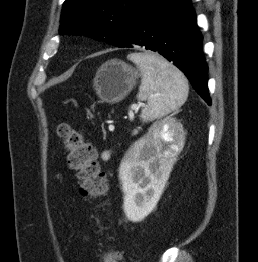 File:Clear cell renal cell carcinoma (Radiopaedia 61449-69393 D 12).jpg