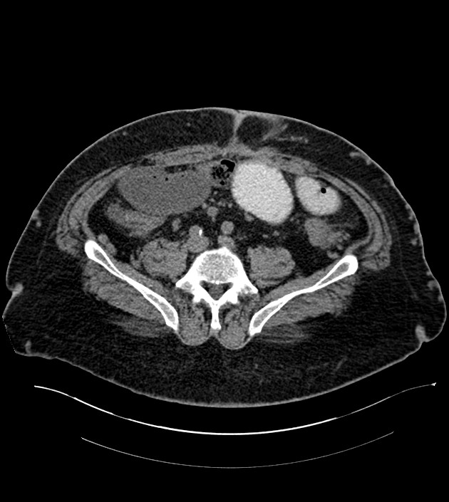 Closed-loop small bowel obstruction-internal hernia (Radiopaedia 78439-91096 Axial non-contrast 107).jpg