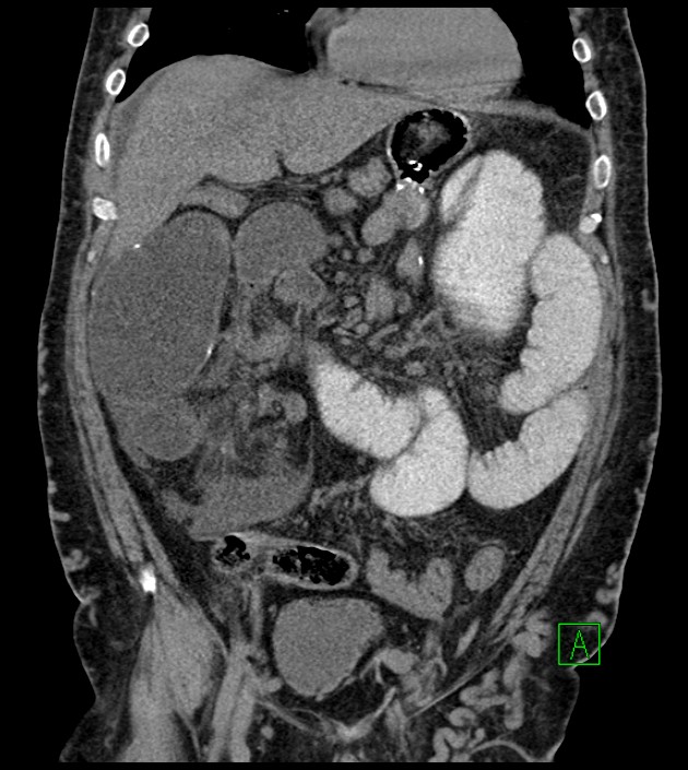 Closed-loop small bowel obstruction-internal hernia (Radiopaedia 78439-91096 Coronal non-contrast 40).jpg