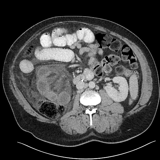 File:Closed loop obstruction - internal hernia into nephrectomy bed (Radiopaedia 59867-67320 Axial 15).jpg