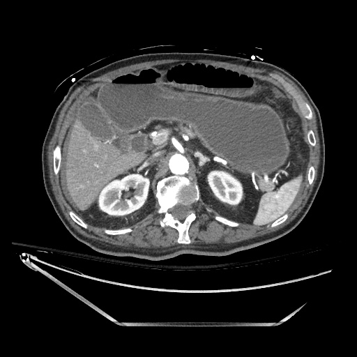 Closed loop obstruction due to adhesive band, resulting in small bowel ischemia and resection (Radiopaedia 83835-99023 B 48).jpg
