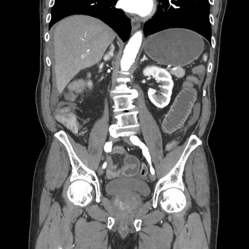 Closed loop obstruction due to adhesive band, resulting in small bowel ischemia and resection (Radiopaedia 83835-99023 C 71).jpg