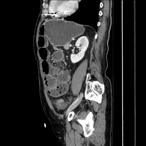 Closed loop obstruction due to adhesive band, resulting in small bowel ischemia and resection (Radiopaedia 83835-99023 F 121).jpg