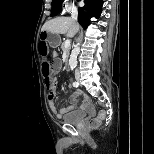 Closed loop obstruction due to adhesive band, resulting in small bowel ischemia and resection (Radiopaedia 83835-99023 F 90).jpg