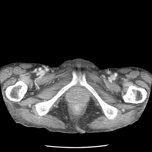 Closed loop small bowel obstruction - adhesions and infarct (Radiopaedia 85125-100678 B 115).jpg
