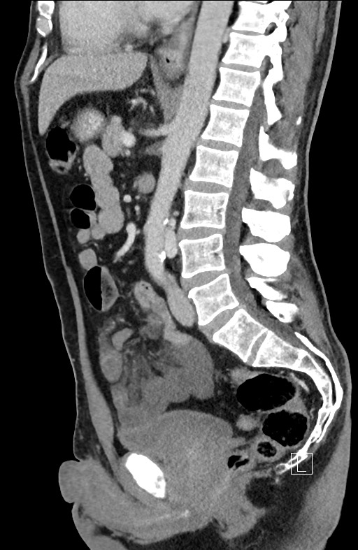 Closed loop small bowel obstruction - internal hernia (Radiopaedia 57806-64778 C 55).jpg