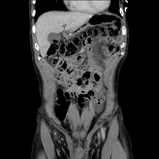 File:Closed loop small bowel obstruction - omental adhesion causing "internal hernia" (Radiopaedia 85129-100682 B 41).jpg