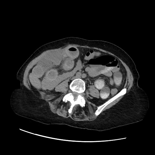 File:Closed loop small bowel obstruction due to adhesive band, with intramural hemorrhage and ischemia (Radiopaedia 83831-99017 Axial 182).jpg