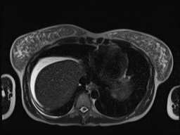 File:Closed loop small bowel obstruction in pregnancy (MRI) (Radiopaedia 87637-104031 Axial T2 7).jpg