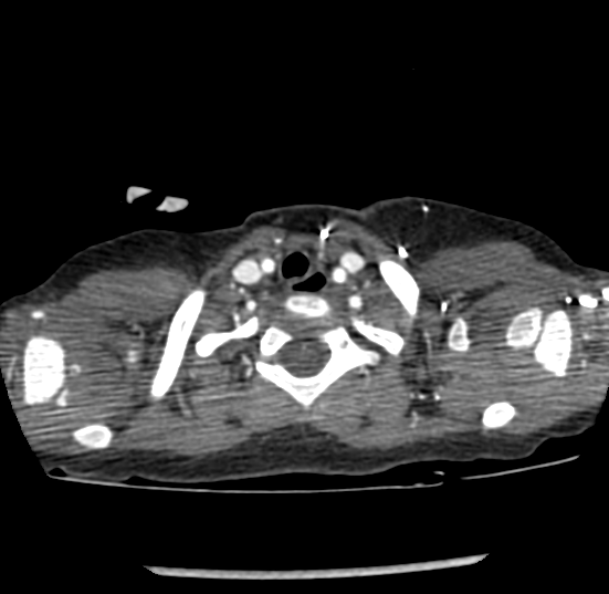 File:Coarctation of aorta (Radiopaedia 27427-27622 Axial C+ CTPA 3).png
