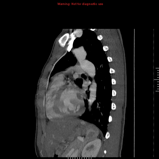 File:Coarctation of the aorta (Radiopaedia 9434-10118 B 39).jpg