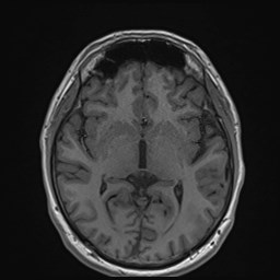 Cochlear incomplete partition type III associated with hypothalamic hamartoma (Radiopaedia 88756-105498 Axial T1 100).jpg