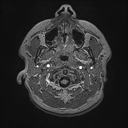 File:Cochlear incomplete partition type III associated with hypothalamic hamartoma (Radiopaedia 88756-105498 Axial T1 22).jpg