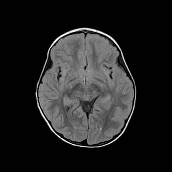 File:Cochlear nerve aplasia - unilateral (Radiopaedia 87910-104413 Axial FLAIR 16).jpg