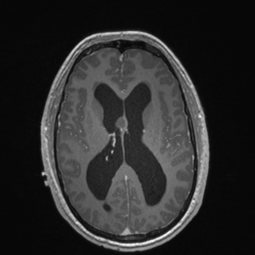 File:Colloid cyst (Radiopaedia 44510-48181 Axial T1 C+ 104).png