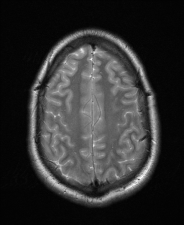File:Colloid cyst (Radiopaedia 44510-48181 Axial T2 23).png