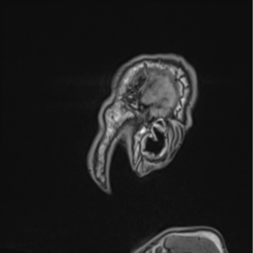 Colloid cyst of the third ventricle (Radiopaedia 86571-102662 Sagittal T1 75).png