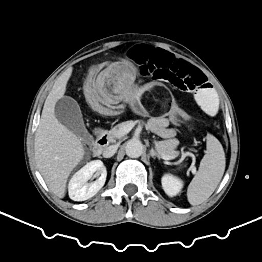 Colocolic intussusception due to large lipoma (Radiopaedia 68773-78482 A 55).jpg