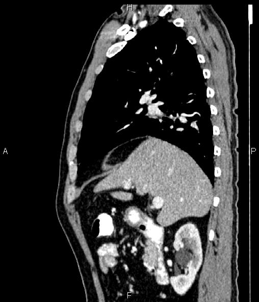 Colon adenocarcinoma (Radiopaedia 83266-97671 D 41).jpg