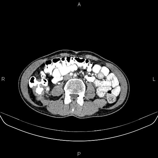 Colon adenocarcinoma - hepatic flexure (Radiopaedia 85635-101395 A 50).jpg