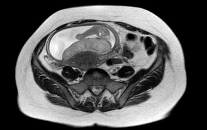 Colon adenocarcinoma with Krukenberg tumors, advanced pregnancy (Radiopaedia 67279-76645 Axial T2 26).jpg