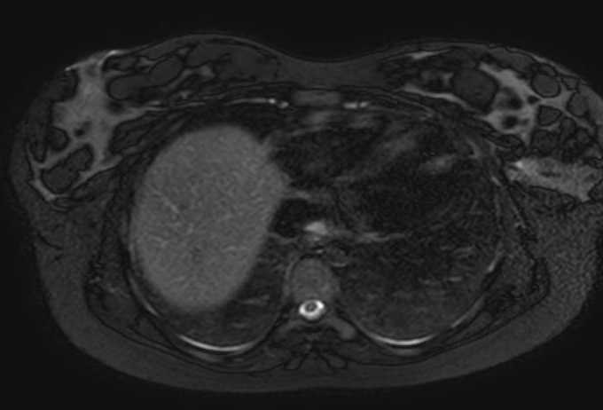 Colon adenocarcinoma with Krukenberg tumors, advanced pregnancy (Radiopaedia 67279-76645 Axial T2 SPAIR 80).jpg