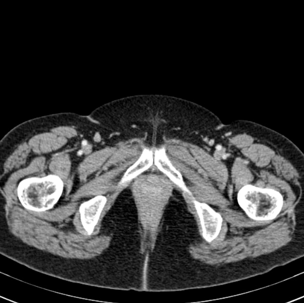 Colon carcinoma with hepatic metastases (Radiopaedia 29477-29961 A 122).jpg