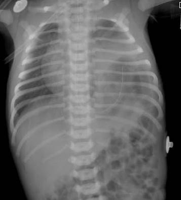 File:Congenital diaphragmatic hernia (Radiopaedia 10033).jpg
