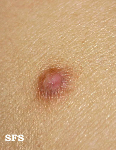 File:Dermatofibroma (Dermatology Atlas 4).jpg