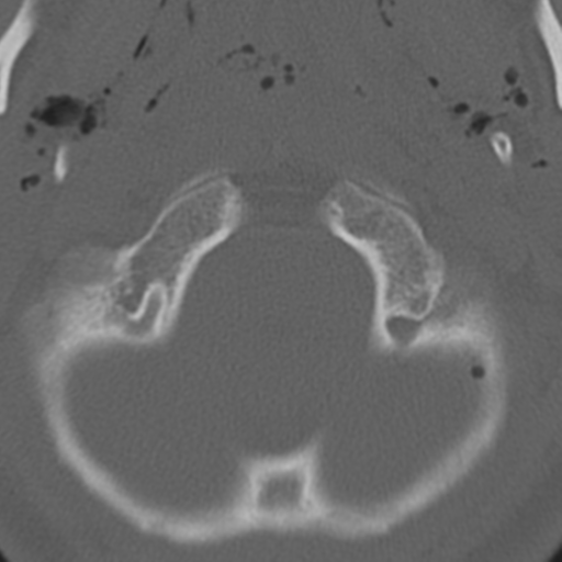 File:Multitrauma with diffuse axonal injury, temporal bone fractures and traumatic caroticocavernous fistula (Radiopaedia 37242-39035 Axial 225).png