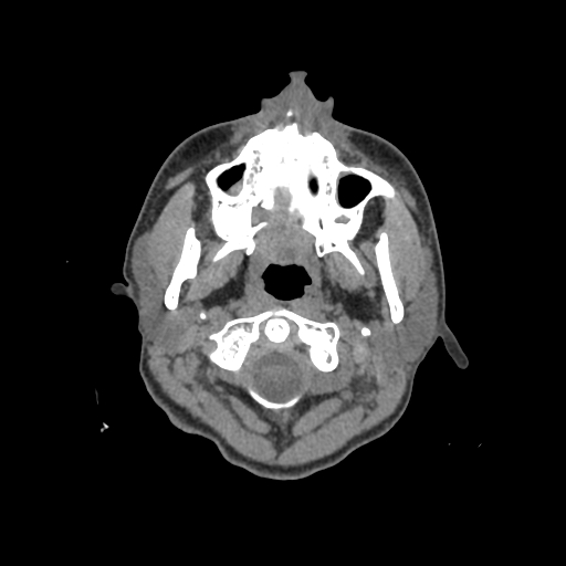 Nasal pyogenic granuloma (lobular capillary hemangioma) (Radiopaedia 85536-101244 Axial non-contrast 4).jpg