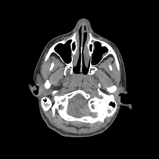 Nasal pyogenic granuloma (lobular capillary hemangioma) (Radiopaedia 85536-101244 Axial non-contrast 47).jpg