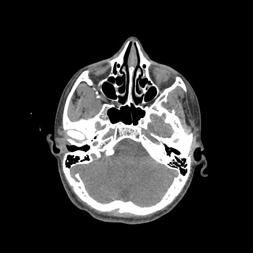 File:Nasal pyogenic granuloma (lobular capillary hemangioma) (Radiopaedia 85536-101244 Axial non-contrast 78).jpg