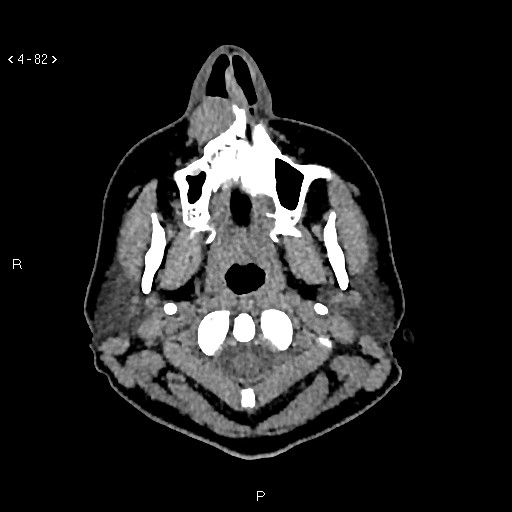File:Nasolabial cyst (Radiopaedia 75125-86194 Axial non-contrast 44).jpg