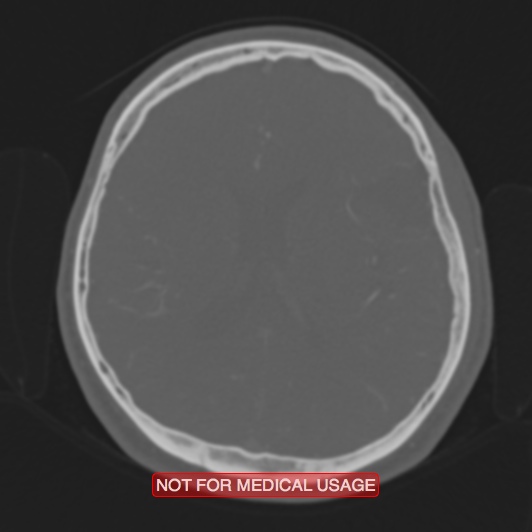 Nasopharyngeal carcinoma recurrence - skull base destruction (Radiopaedia 29107-29490 Axial bone window 43).jpg