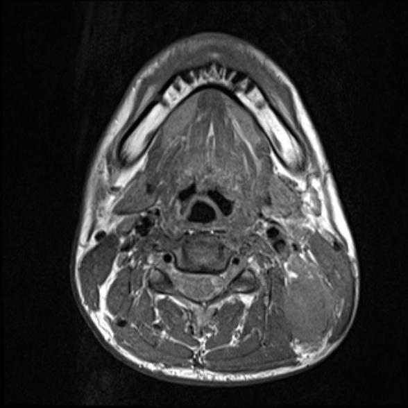 Nasopharyngeal carcinoma with skull base invasion (Radiopaedia 53415-59485 Axial T1 48).jpg