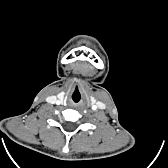 Nasopharyngeal carcinoma with skull base invasion (Radiopaedia 53415-59705 A 152).jpg