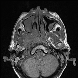 Nasopharyngeal carcinoma with skull base invasion (Radiopaedia 59258-66600 B 19).jpg