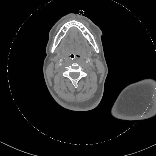 Neck CT angiogram (intraosseous vascular access) (Radiopaedia 55481-61945 B 199).jpg