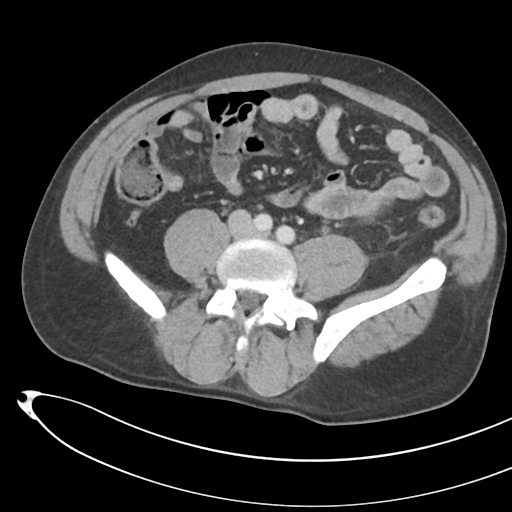 File:Necrotizing pancreatitis with acute necrotic collections (Radiopaedia 38829-41012 B 53).png