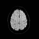 File:Neuro-Behcet's disease (Radiopaedia 21557-21506 Axial DWI 22).jpg